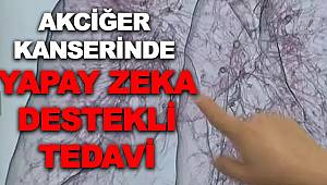 Akciğer kanserinde yapay zeka destekli tedavi 