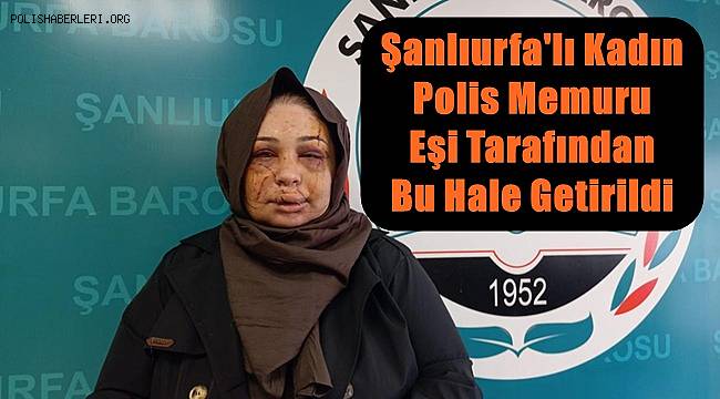 Şanlıurfalı Kadın Polis Memuru Eşi Tarafından Darp Edilip Bu Hale Geldi