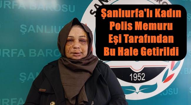 Şanlıurfalı Kadın Polis Memuru Eşi Tarafından Darp Edilip Bu Hale Geldi